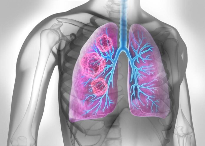 Investigación israelí: el líquido pulmonar puede servir de base para las vacunas contra el cáncer