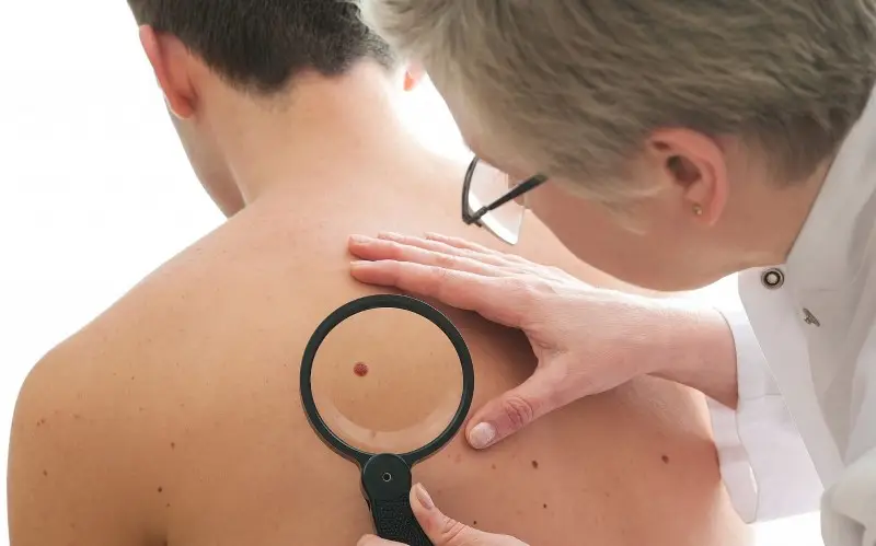 un dermatólogo revisando un lunar de un paciente en busca de signos de melanoma.